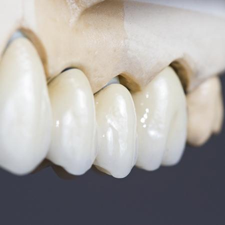 Dental bridge on a model