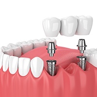 3D render of a dental bridge