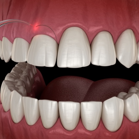 Animated smile during gum recontouring treatment