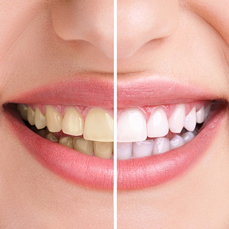 Smile before and after teeth whitening