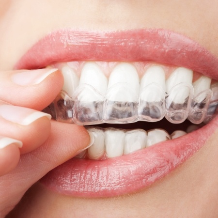 Dental patient placing Invisalign tray