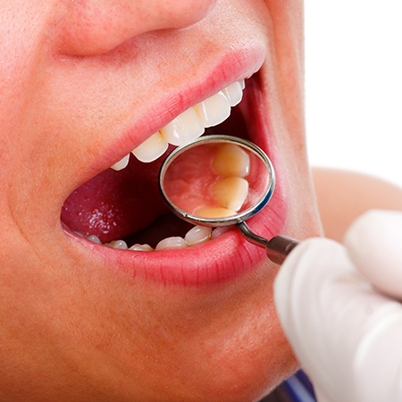 Dental patient receiving oral cancer screening