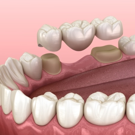 Animated smile during dental bridge placement