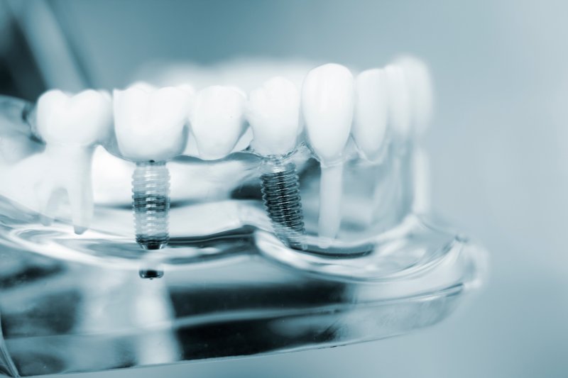 teeth representing dental implants worth the cost in White Plains